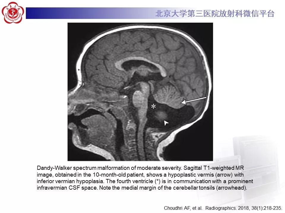 【病例】Dandy-Walker综合征1例CT及MR影像