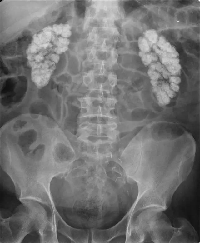 这6种典型影像征象你不一定都认识 这6种典型影像征象你不一定都认识