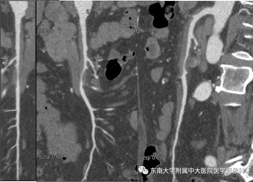 【病例】肠系膜上动脉栓塞2例CT影像