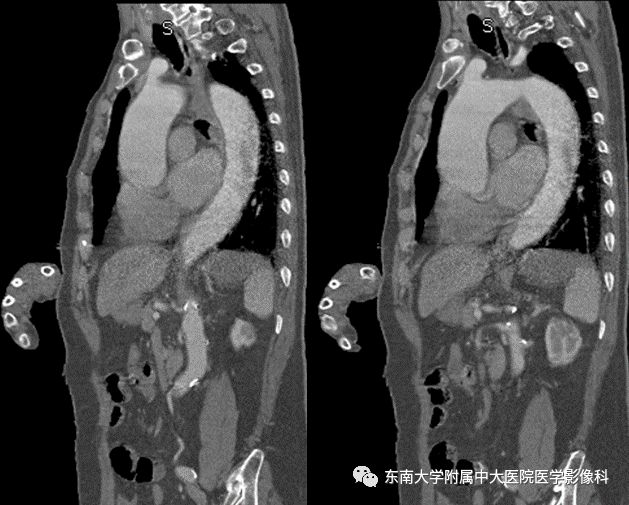 【病例】肠系膜上动脉栓塞2例CT影像