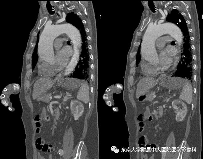 【病例】肠系膜上动脉栓塞2例CT影像