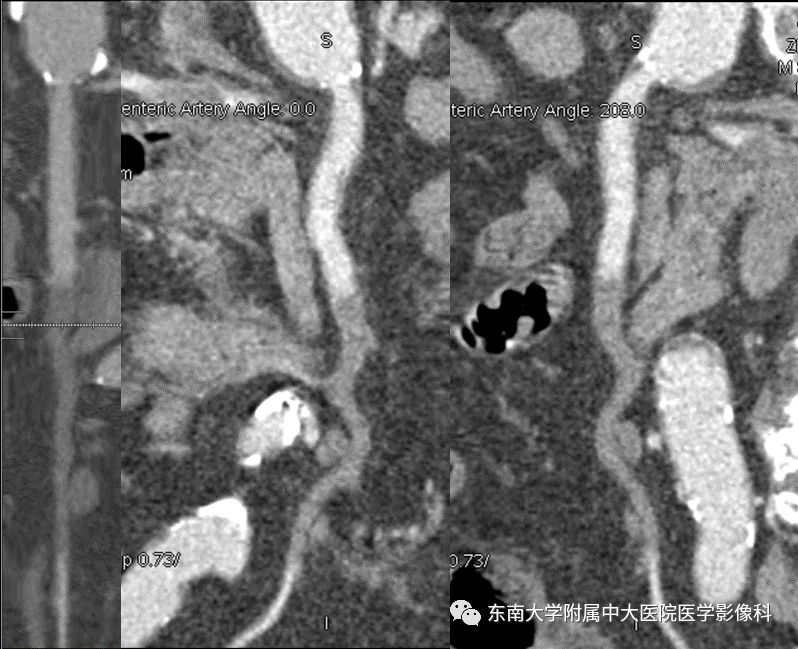 【病例】肠系膜上动脉栓塞2例CT影像