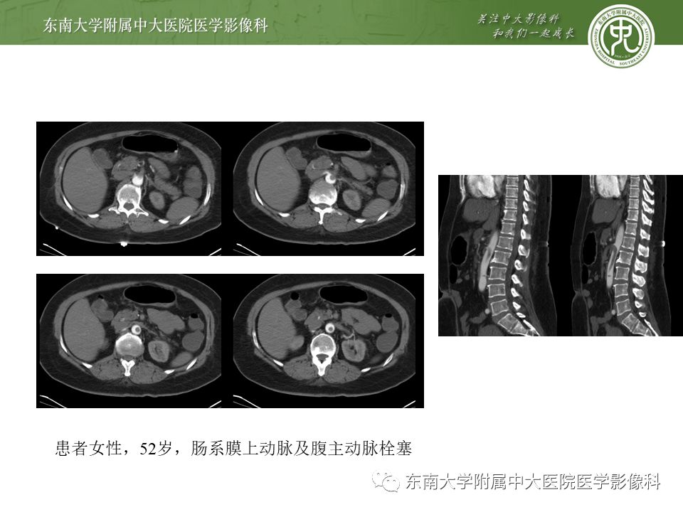 【病例】肠系膜上动脉栓塞2例CT影像