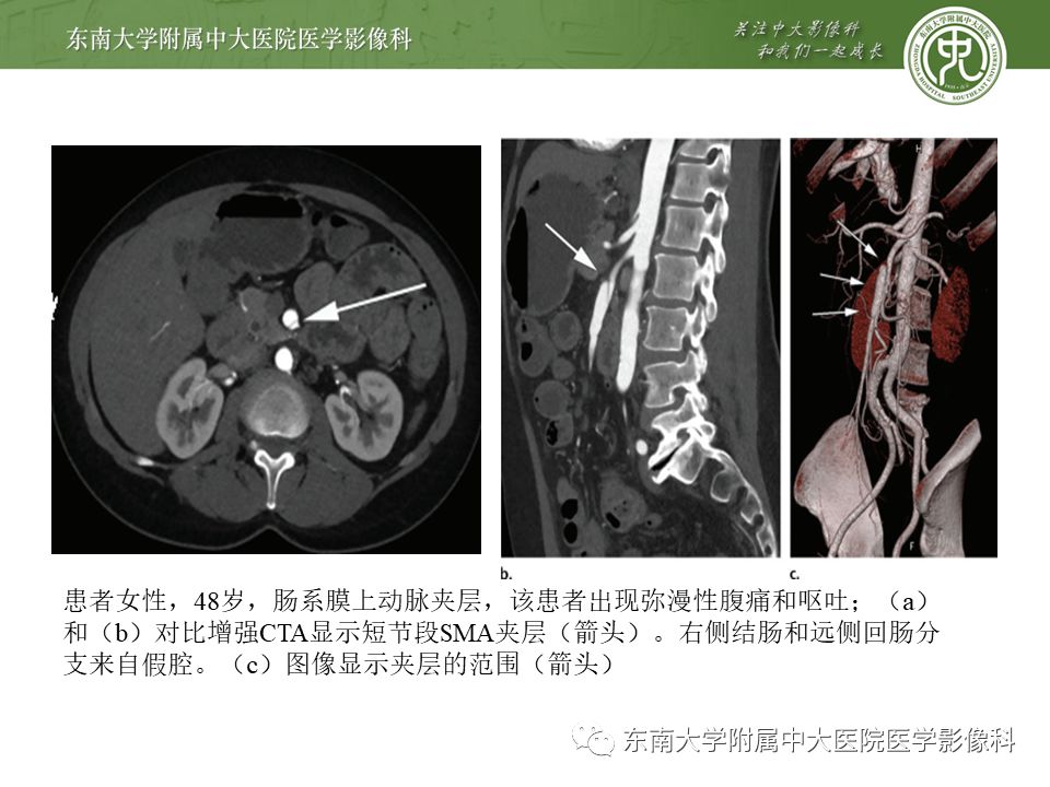 【病例】肠系膜上动脉栓塞2例CT影像