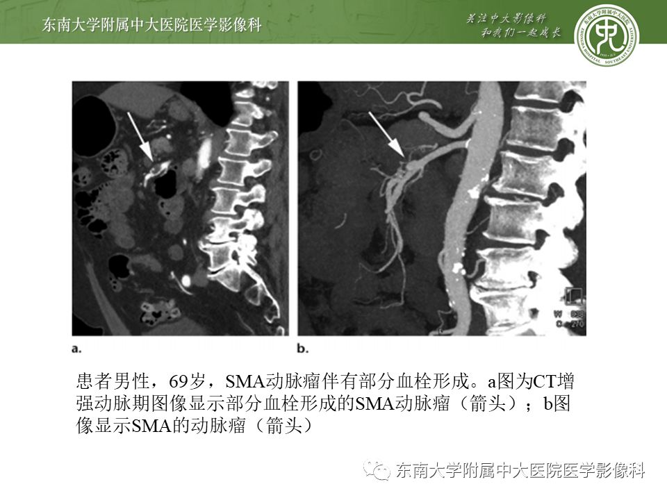 【病例】肠系膜上动脉栓塞2例CT影像