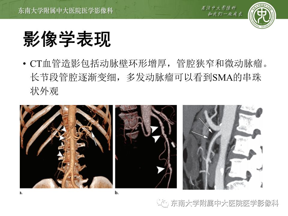 【病例】肠系膜上动脉栓塞2例CT影像