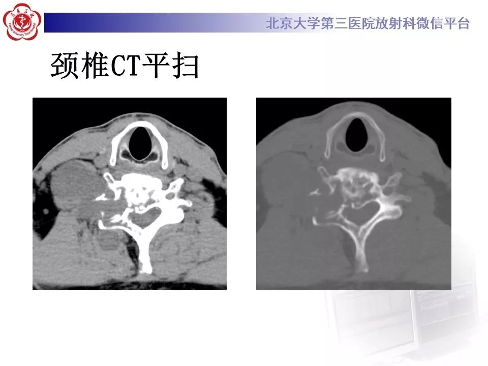 【病例】脊柱神经鞘瘤1例CT及MR