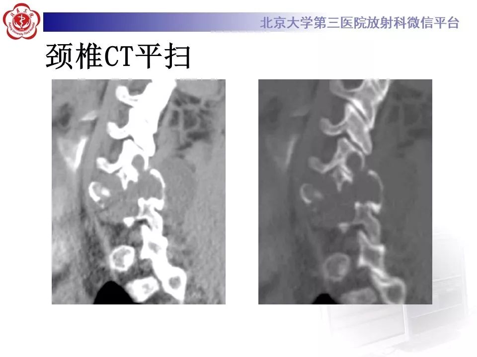 【病例】脊柱神经鞘瘤1例CT及MR