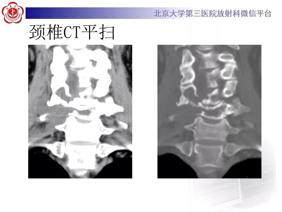 【病例】脊柱神经鞘瘤1例CT及MR