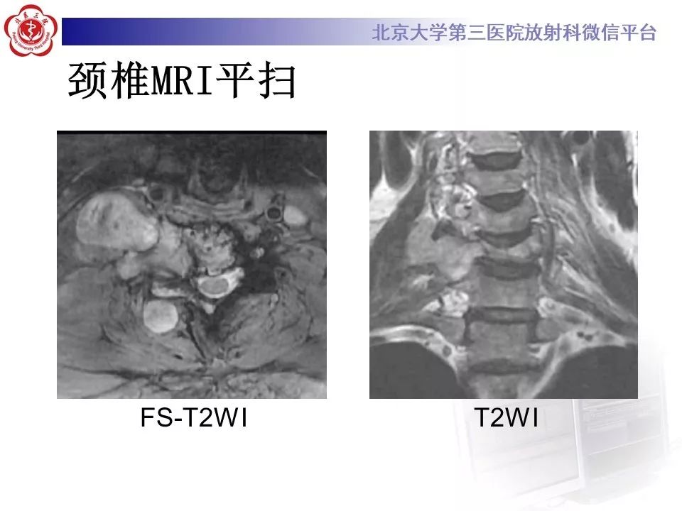 【病例】脊柱神经鞘瘤1例CT及MR