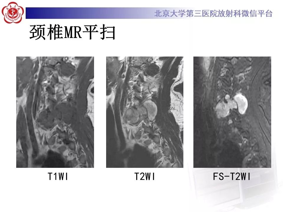 【病例】脊柱神经鞘瘤1例CT及MR