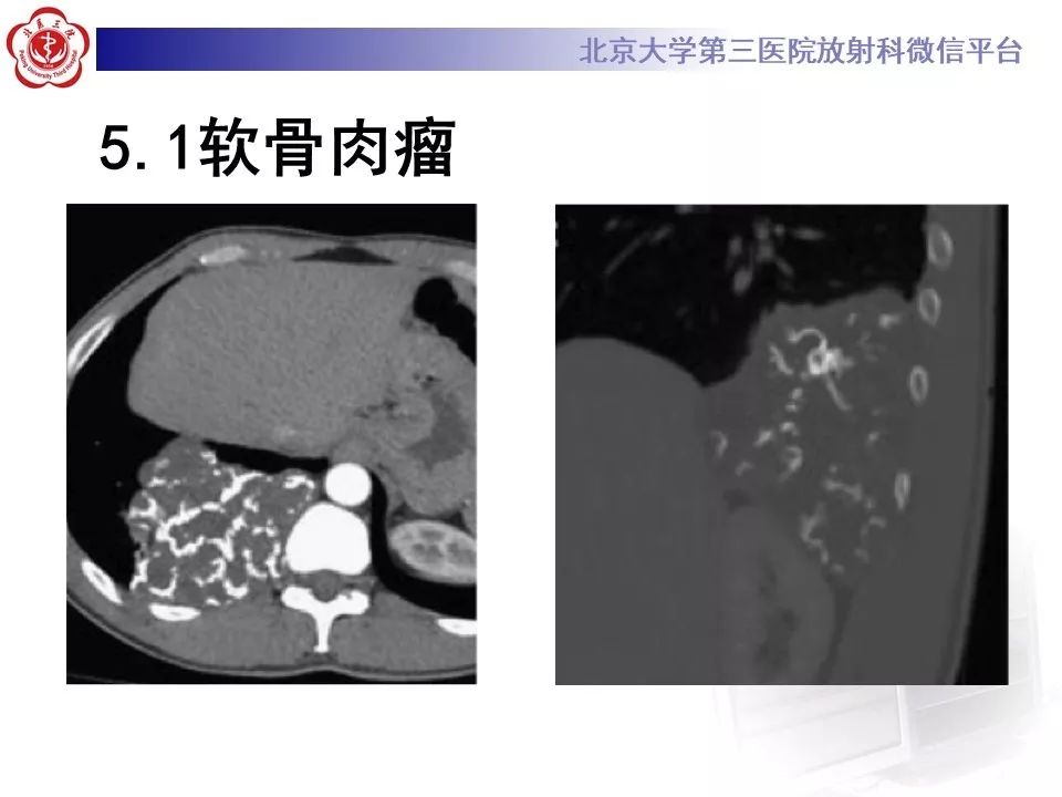 【病例】脊柱神经鞘瘤1例CT及MR