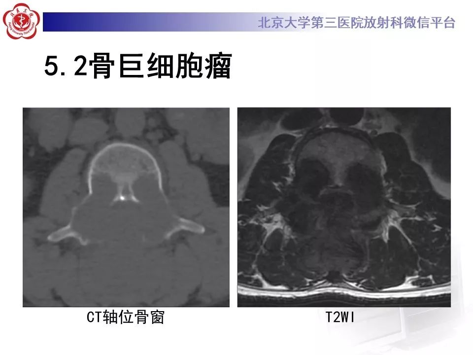 【病例】脊柱神经鞘瘤1例CT及MR