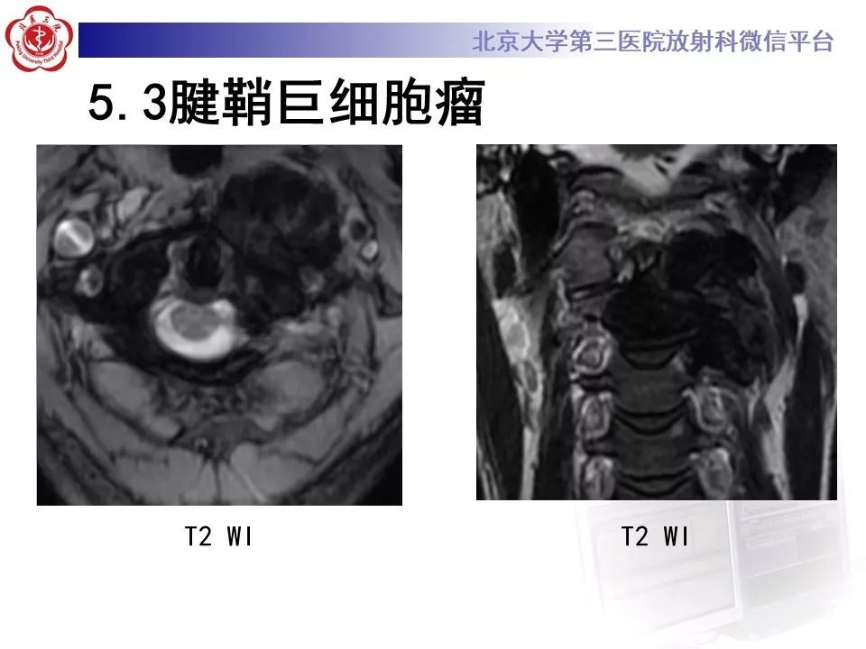 【病例】脊柱神经鞘瘤1例CT及MR