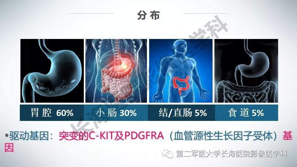 【PPT】胃间质瘤的影像评估