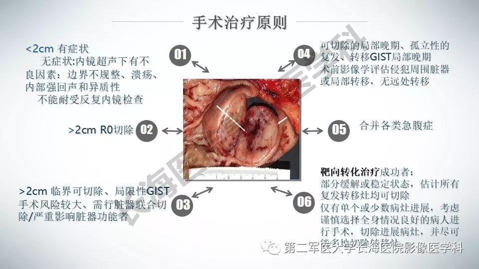 【PPT】胃间质瘤的影像评估