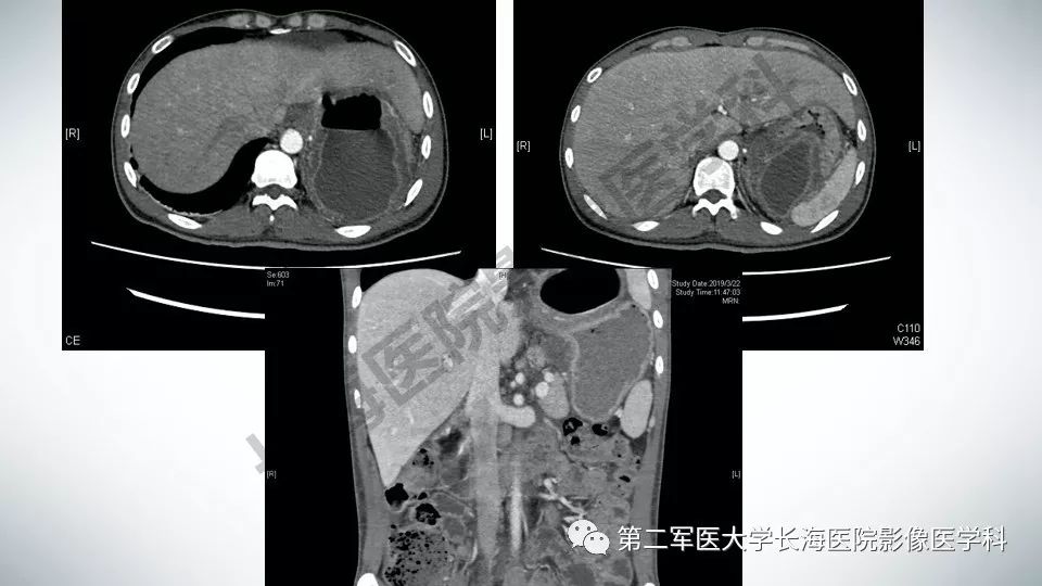 【PPT】胃间质瘤的影像评估