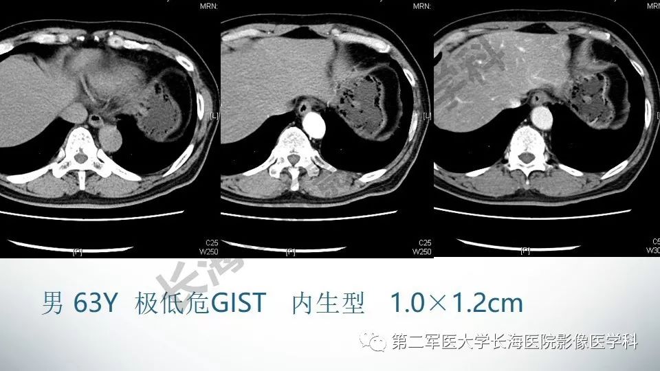 【PPT】胃间质瘤的影像评估