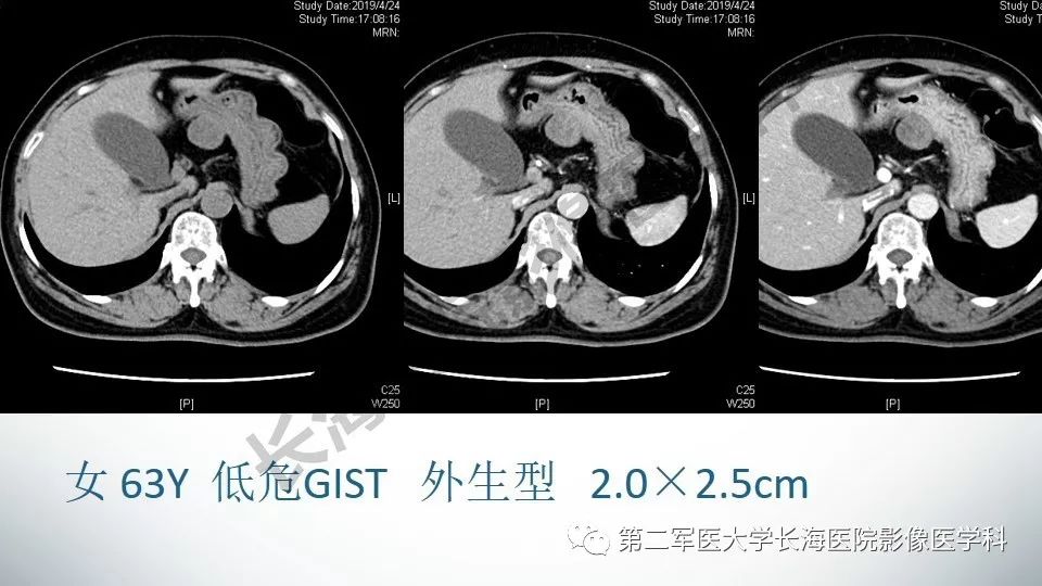 【PPT】胃间质瘤的影像评估