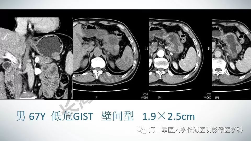 【PPT】胃间质瘤的影像评估