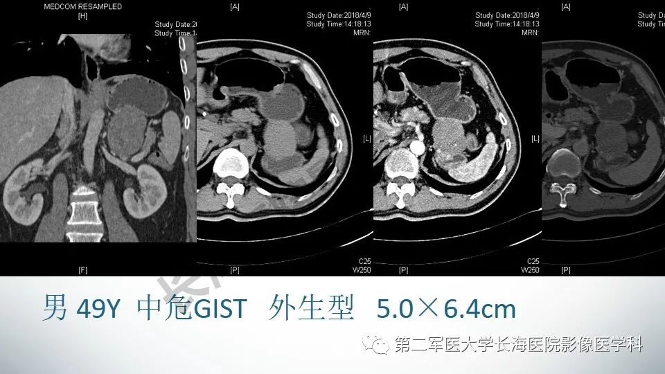 【PPT】胃间质瘤的影像评估