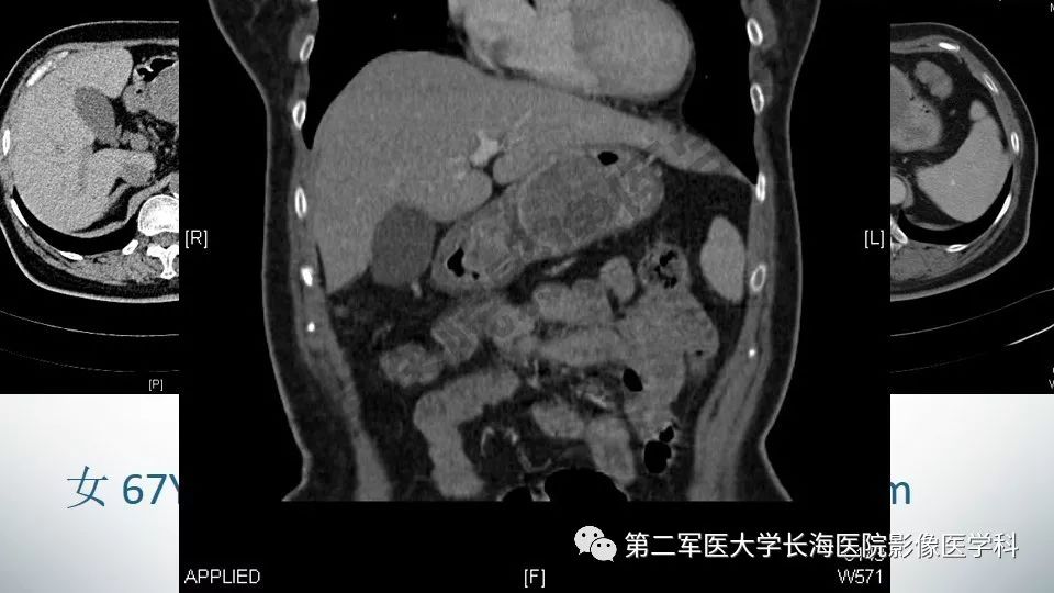 【PPT】胃间质瘤的影像评估
