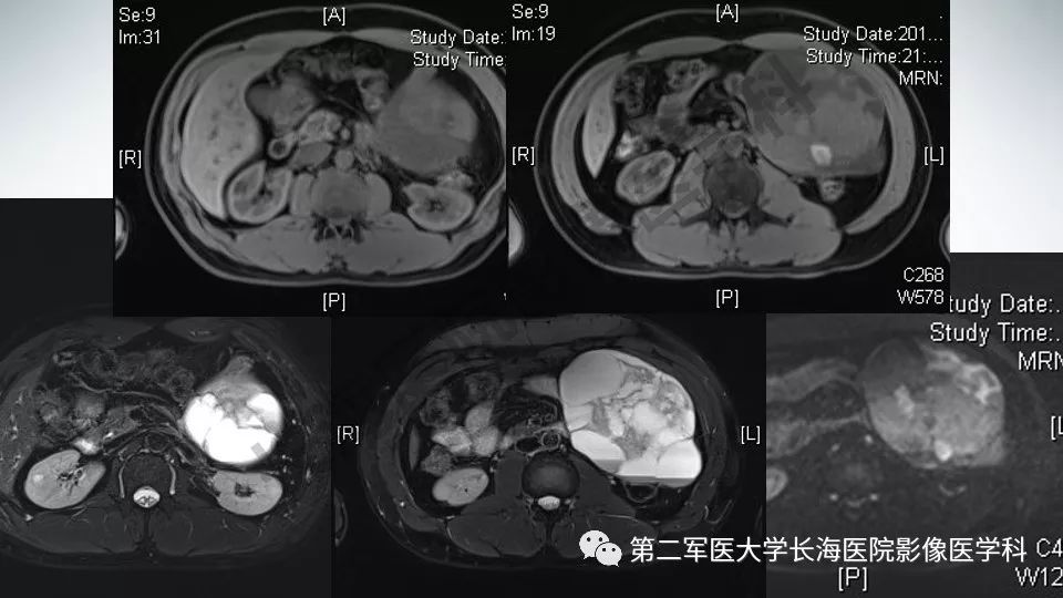 【PPT】胃间质瘤的影像评估