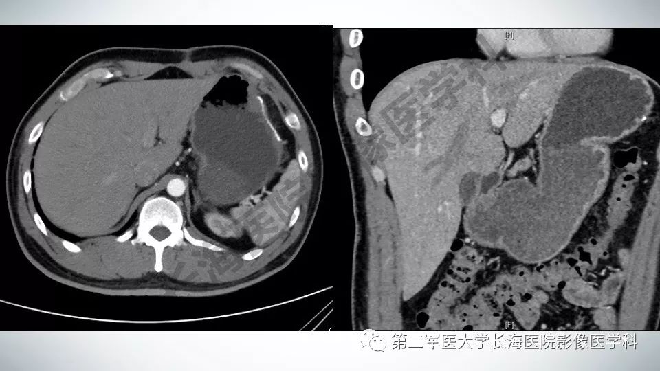 【PPT】胃间质瘤的影像评估