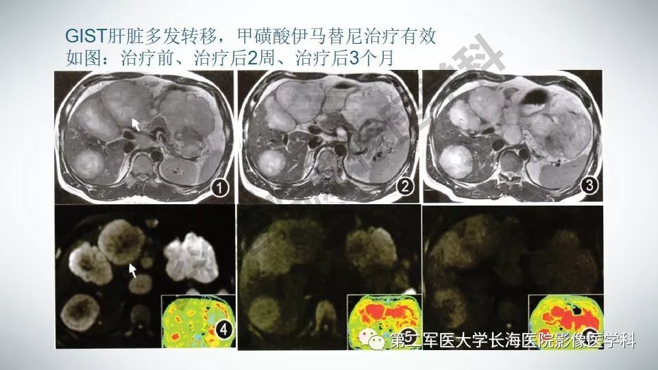 【PPT】胃间质瘤的影像评估