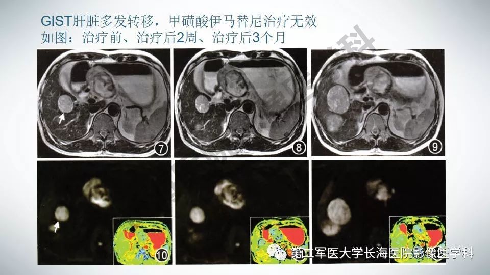 【PPT】胃间质瘤的影像评估
