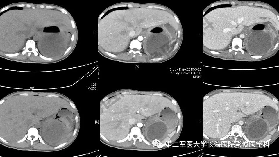 【PPT】胃间质瘤的影像评估