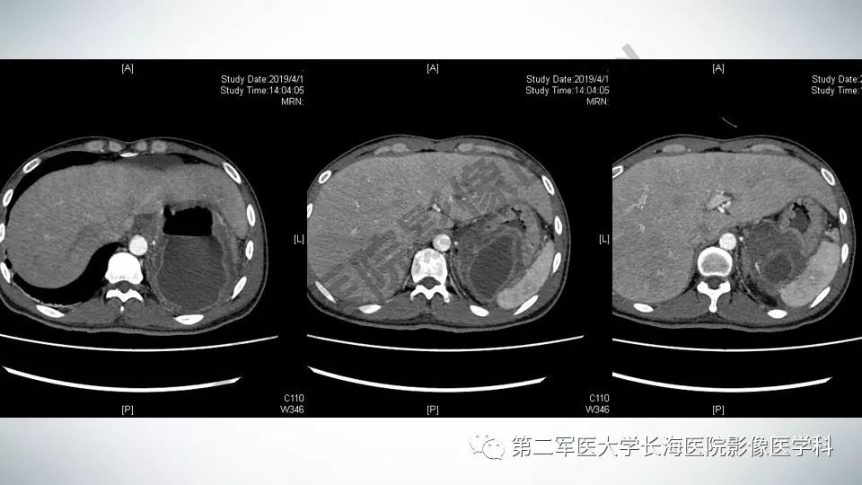 【PPT】胃间质瘤的影像评估