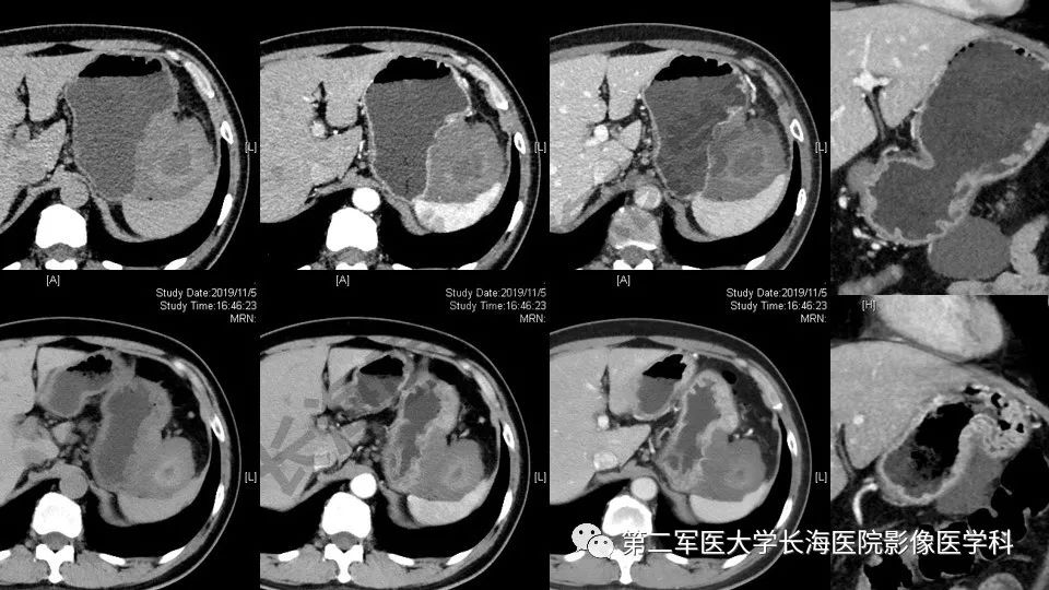 【PPT】胃间质瘤的影像评估