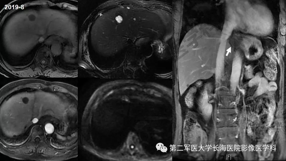 【PPT】胃间质瘤的影像评估