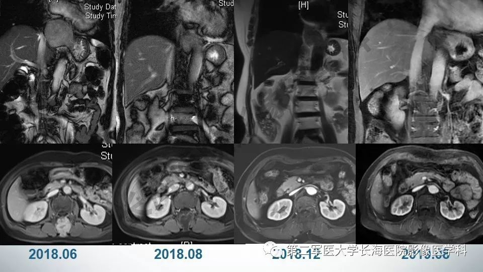 【PPT】胃间质瘤的影像评估