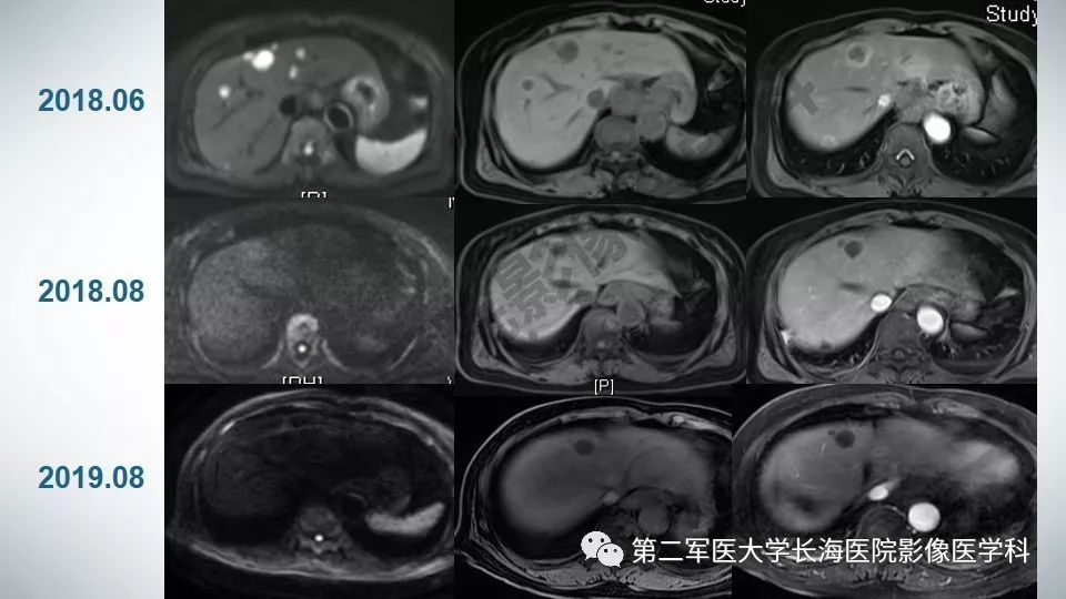 【PPT】胃间质瘤的影像评估