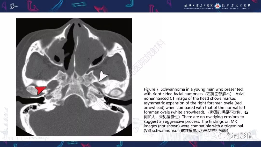 【PPT】颅底急诊病变CT影像诊断