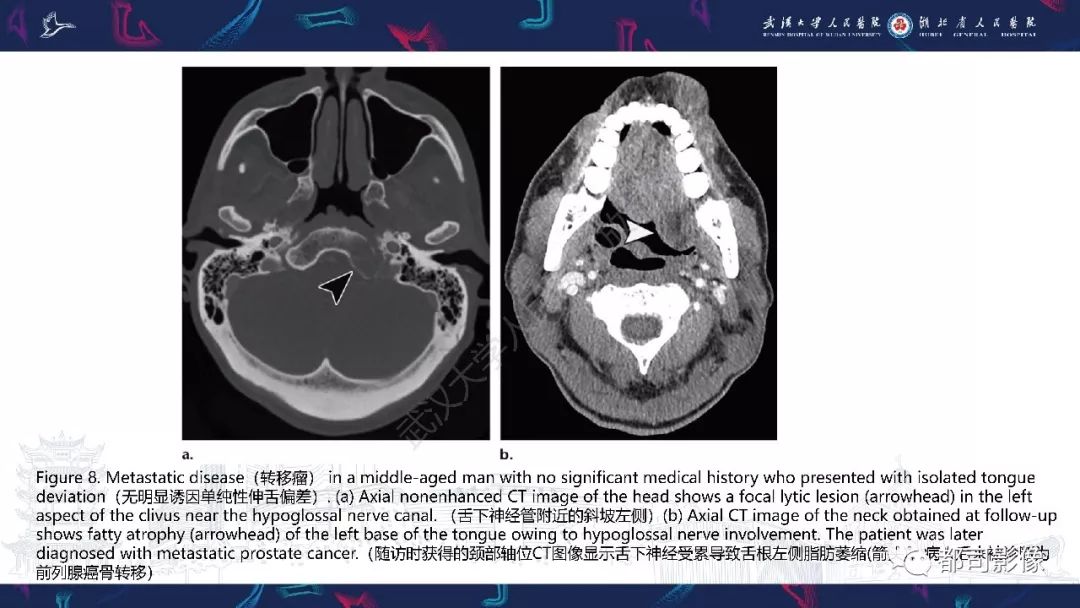 【PPT】颅底急诊病变CT影像诊断