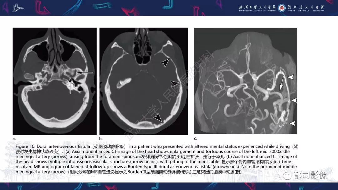 【PPT】颅底急诊病变CT影像诊断