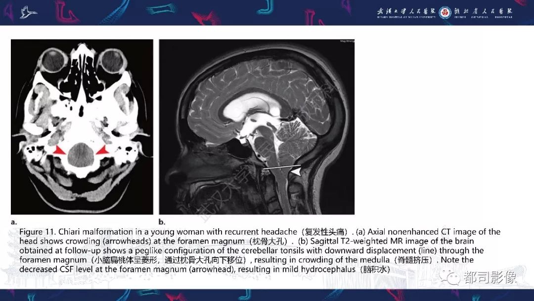 【PPT】颅底急诊病变CT影像诊断
