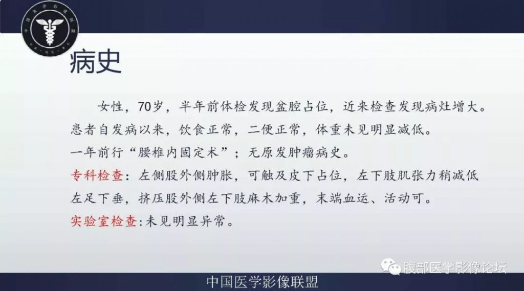 【病例】盆腔低级别去分化脂肪肉瘤1例CT及MR影像