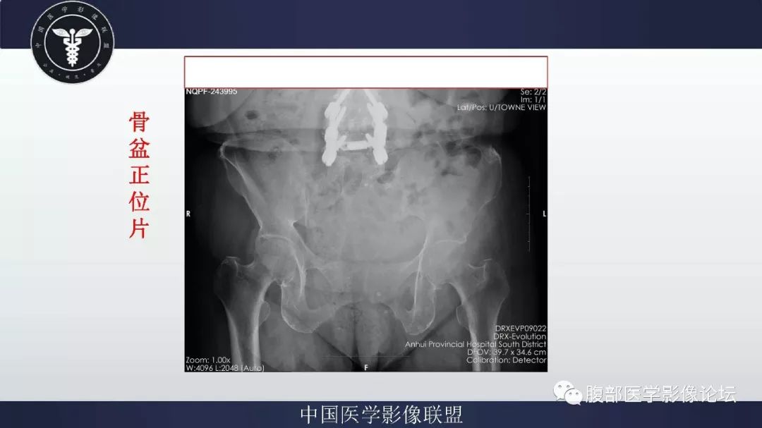 【病例】盆腔低级别去分化脂肪肉瘤1例CT及MR影像