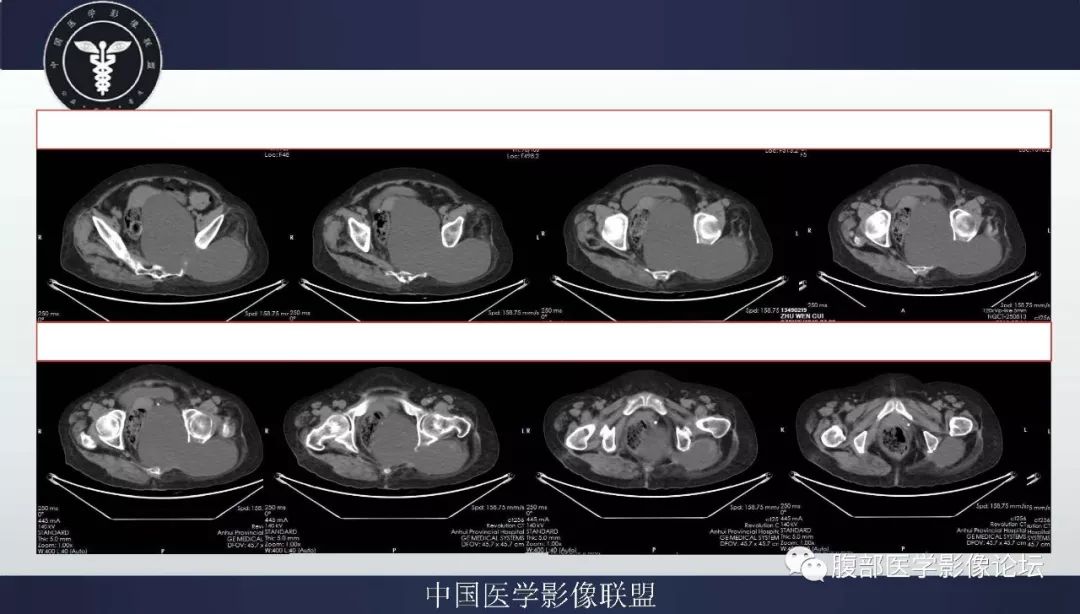 【病例】盆腔低级别去分化脂肪肉瘤1例CT及MR影像