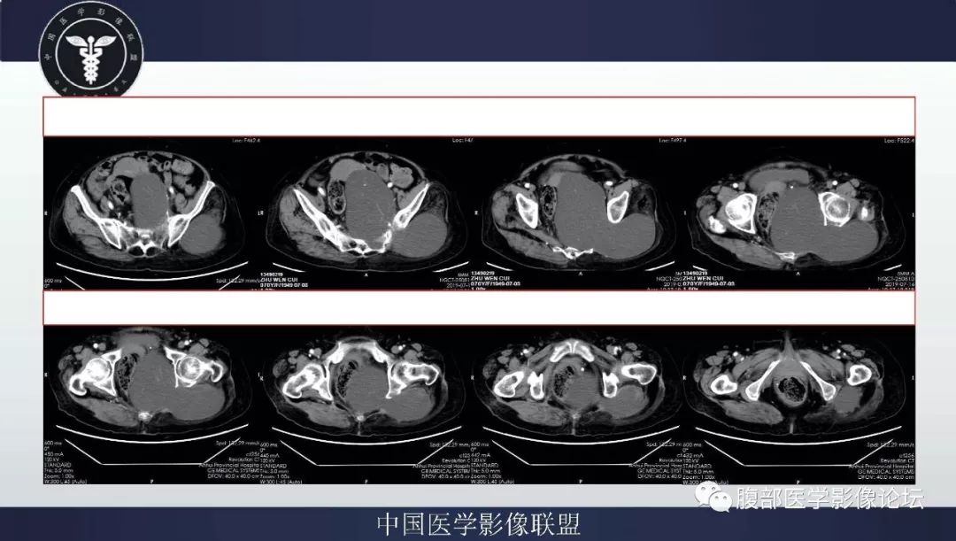 【病例】盆腔低级别去分化脂肪肉瘤1例CT及MR影像