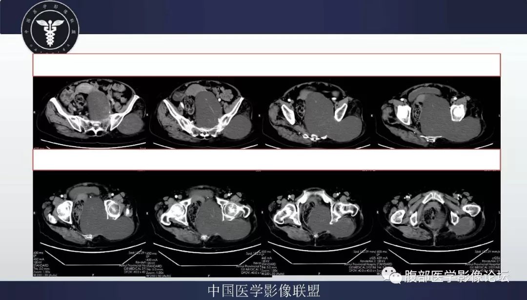 【病例】盆腔低级别去分化脂肪肉瘤1例CT及MR影像