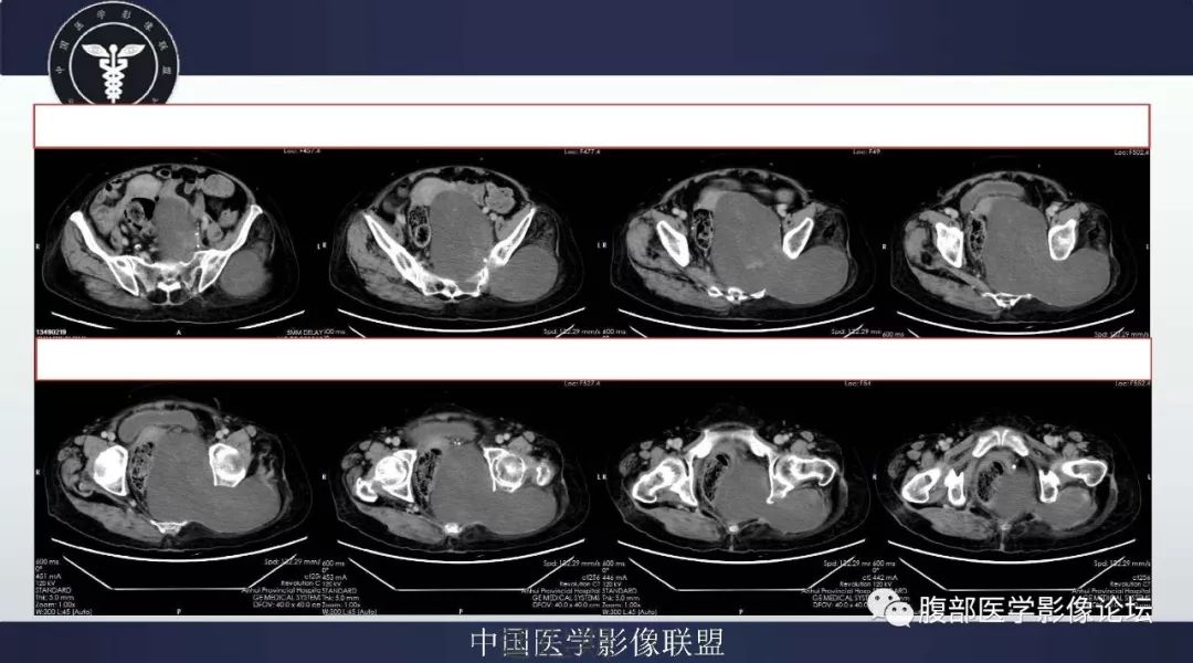 【病例】盆腔低级别去分化脂肪肉瘤1例CT及MR影像