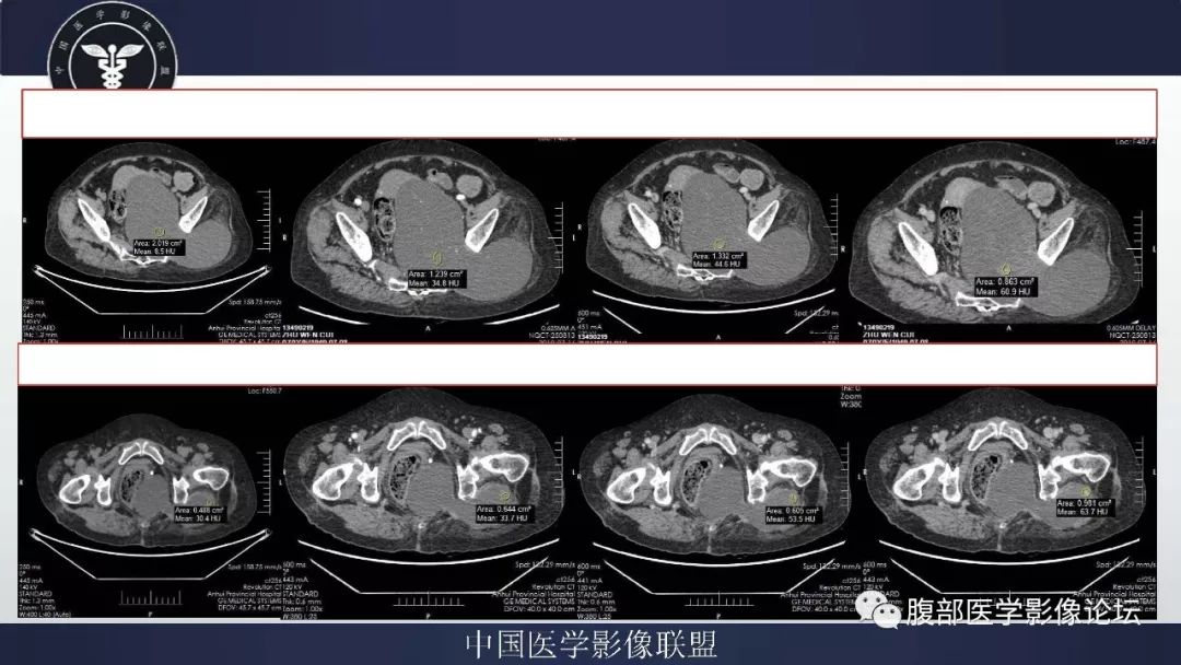 【病例】盆腔低级别去分化脂肪肉瘤1例CT及MR影像