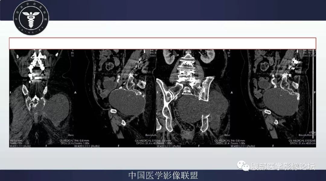 【病例】盆腔低级别去分化脂肪肉瘤1例CT及MR影像