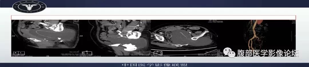 【病例】盆腔低级别去分化脂肪肉瘤1例CT及MR影像