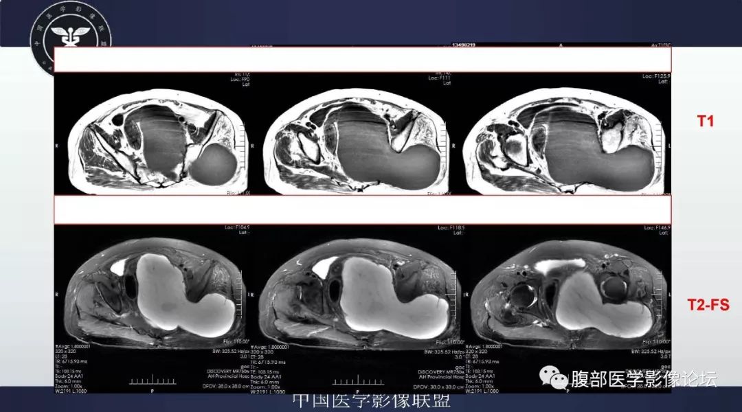 【病例】盆腔低级别去分化脂肪肉瘤1例CT及MR影像